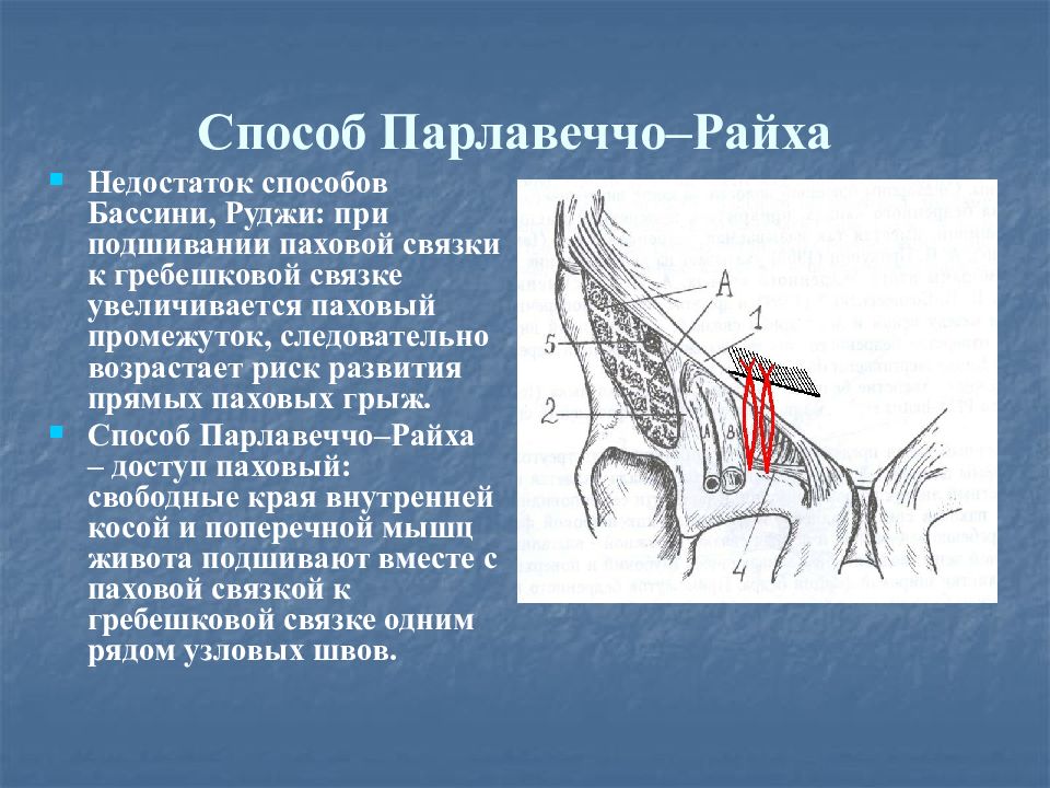 Бедренный способ. Операция Руджи Парлавеччио. Пластика бедренного канала по Руджи Парлавеччо. Способ Бассини при бедренной грыже. Пластика бедренных грыж Руджи—Парлавеччио.