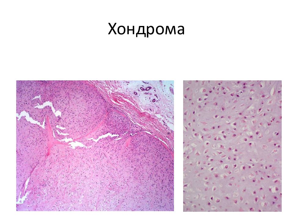 Хондрома. Хондрома патологическая анатомия. Хондрома патанатомия препарат. Хондрома патоморфология.