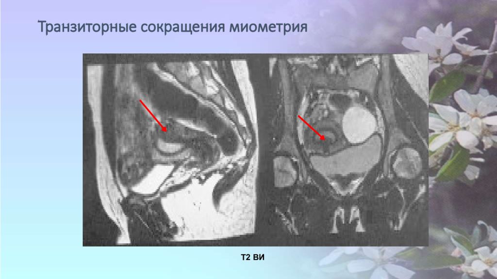 Образование в малом тазу у женщин. Сокращение миометрия.