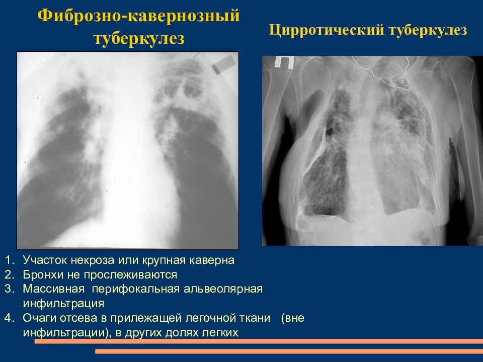 Кавернозный туберкулез презентация