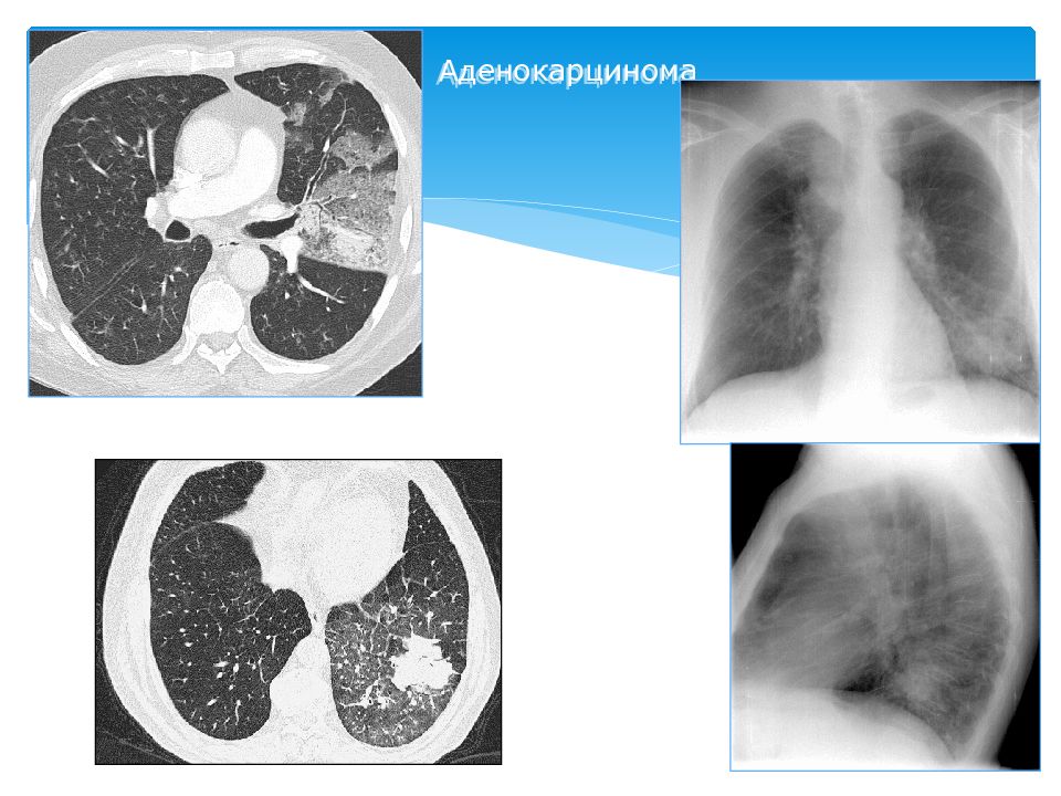 Аденокарцинома легкого. Аденокарцинома рентген. Диффузная аденокарцинома легкого на кт. Аденокарцинома желудка рентген.