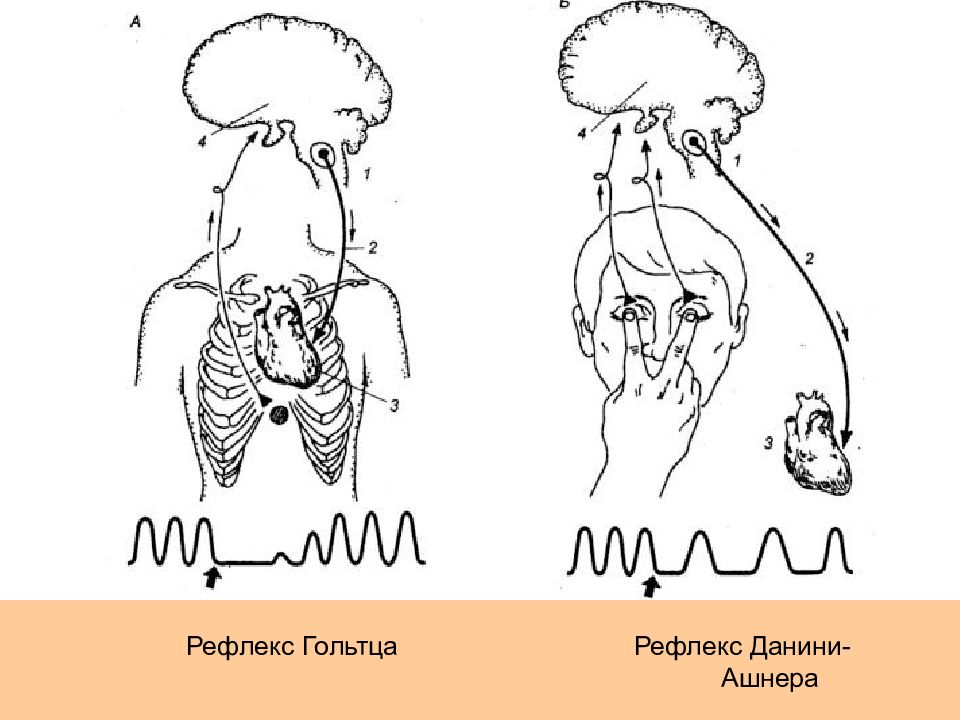 Глазосердечный рефлекс схема