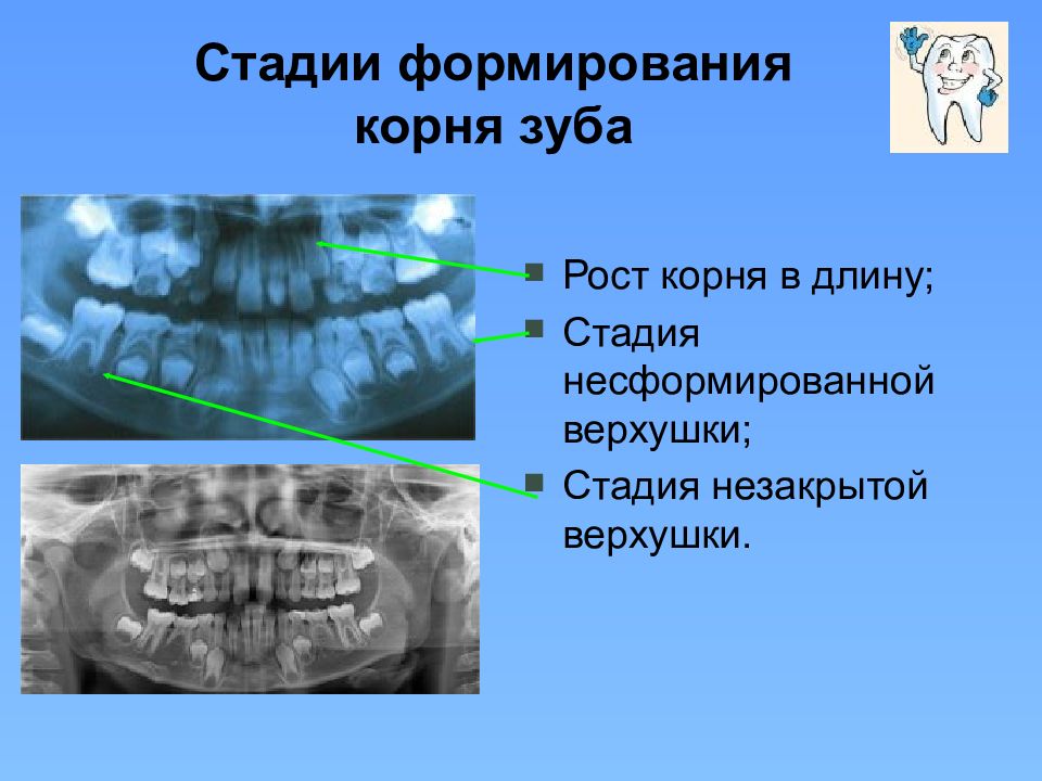 Рентгенологическая картина зубов и их зачатков на различных этапах формирования