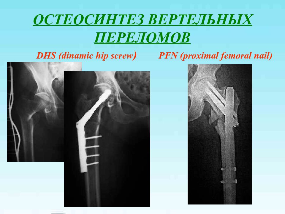 Перелом бедренной кости кроме проксимального отдела. Чрезвертельный перелом рентген. Переломы проксимального отдела бедра. Чрезвертельный перелом бедра остеосинтез. Переломы проксимального отдела бедренной кости.