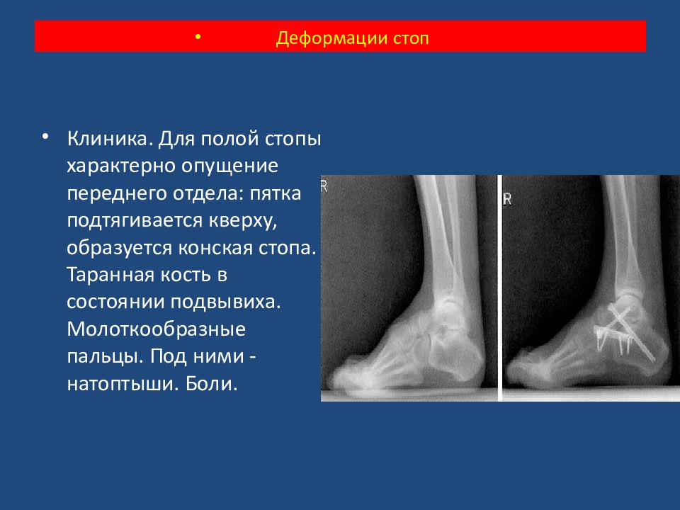 Деформации стоп презентация