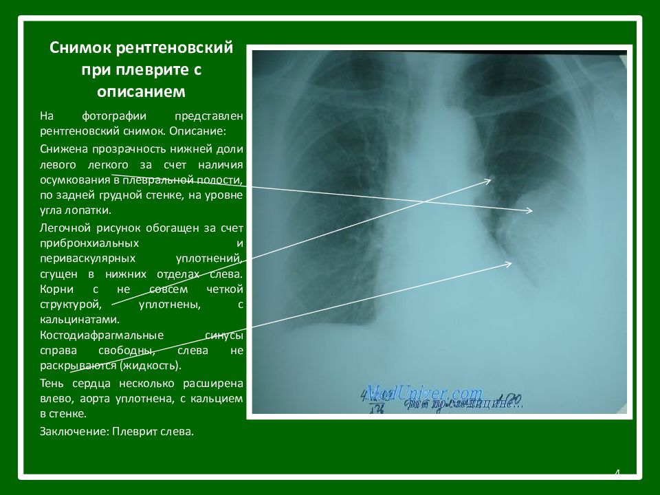 Плеврит легких на рентгене фото