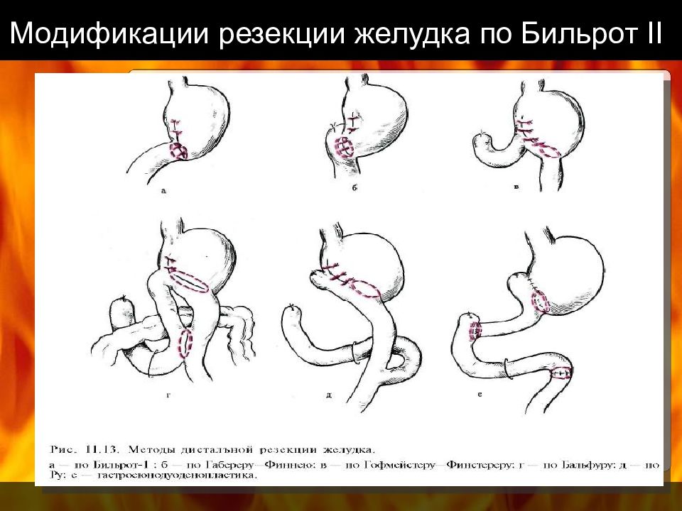 Резекция желудка по витебскому схема операции