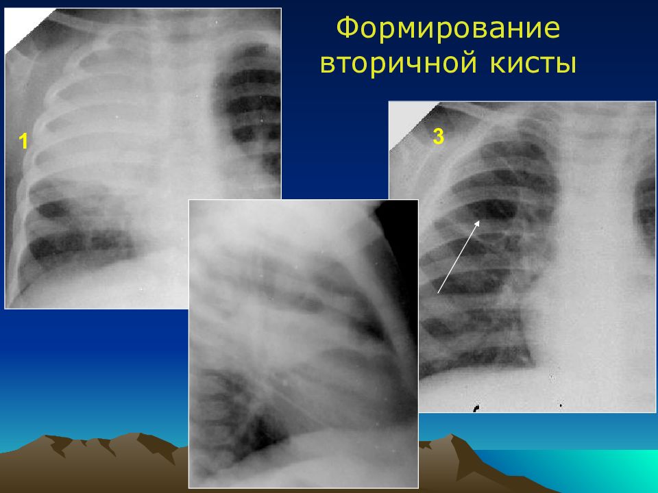 Острая гнойная деструктивная пневмония у детей презентация