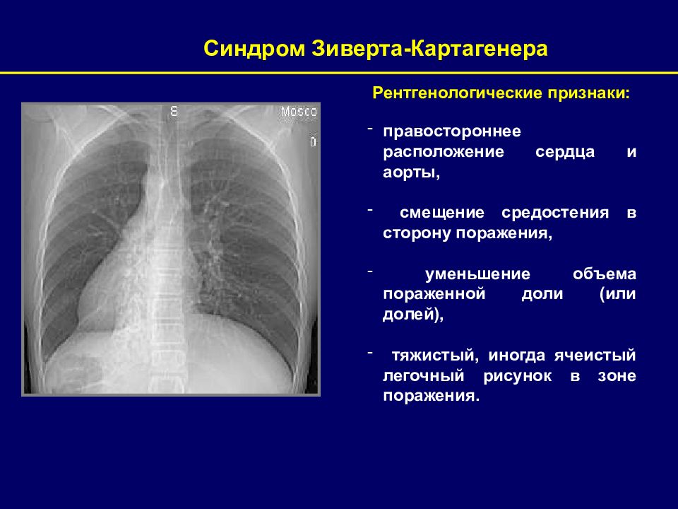 Деформация легочного рисунка. Синдром Картагенера симптомы. Синдром Зиверта-Картагенера. Декстрокардия синдром Картагенера. Проявления синдрома Картагенера.