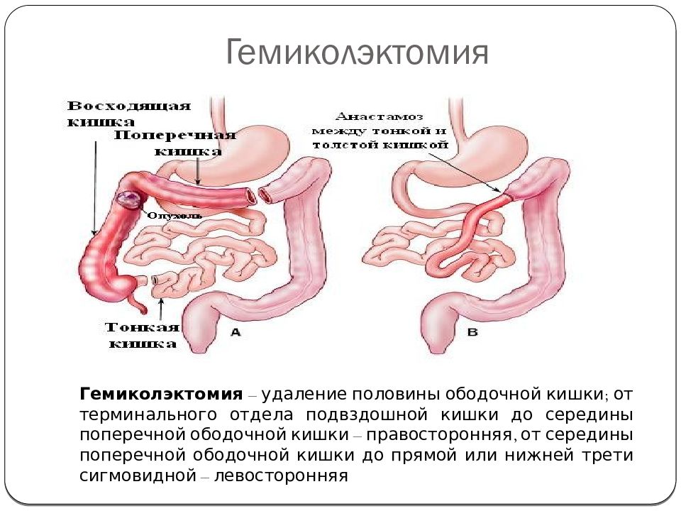 Операция На Прямой Кишке Фото