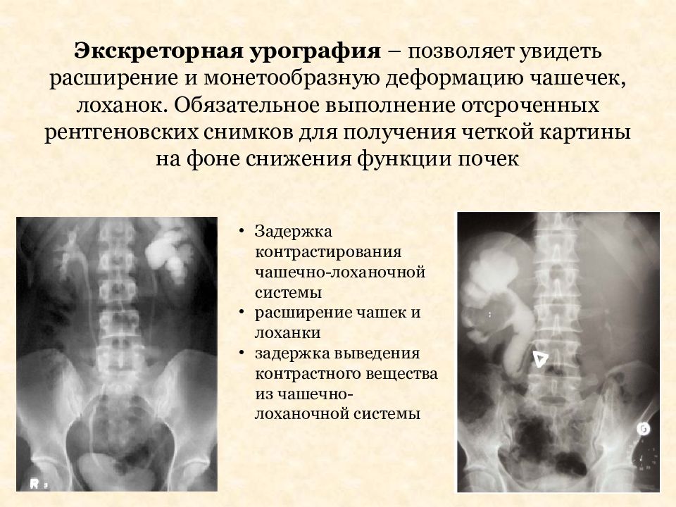 Экскреторная урография презентация