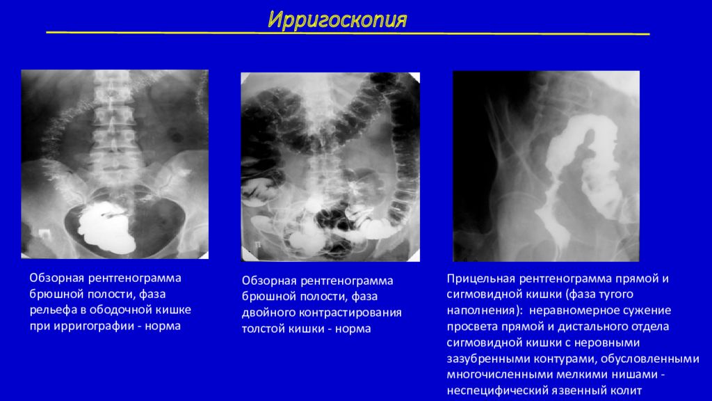 Ирригоскопия екатеринбург. Ирригоскопия презентация.