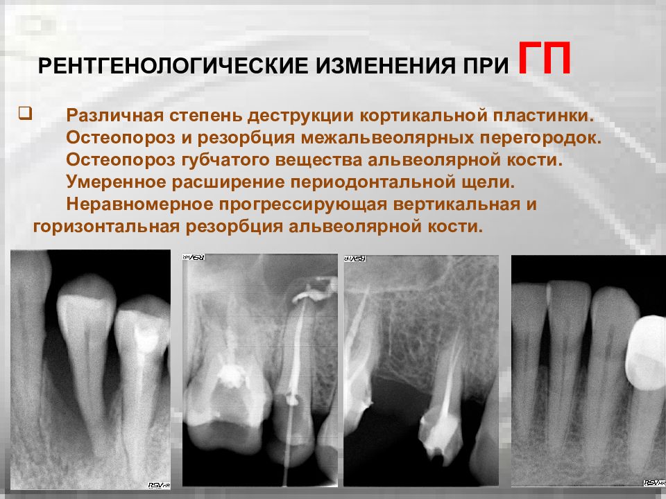 Умеренное расширение. Резорбция костной ткани рентген. Вертикальная резорбция костной ткани. Резорбция альвеолярной кости. Вертикальная и горизонтальная резорбция.