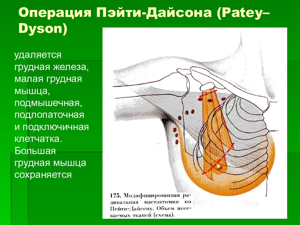 Цикл молочной железы. Радикальная мастэктомия молочной железы. Модифицированная радикальная мастэктомия по пейти. Радикальная мастэктомия по пейти-Дайсону это. Модифицированная радикальная мастэктомия по пейти-Дайсену.