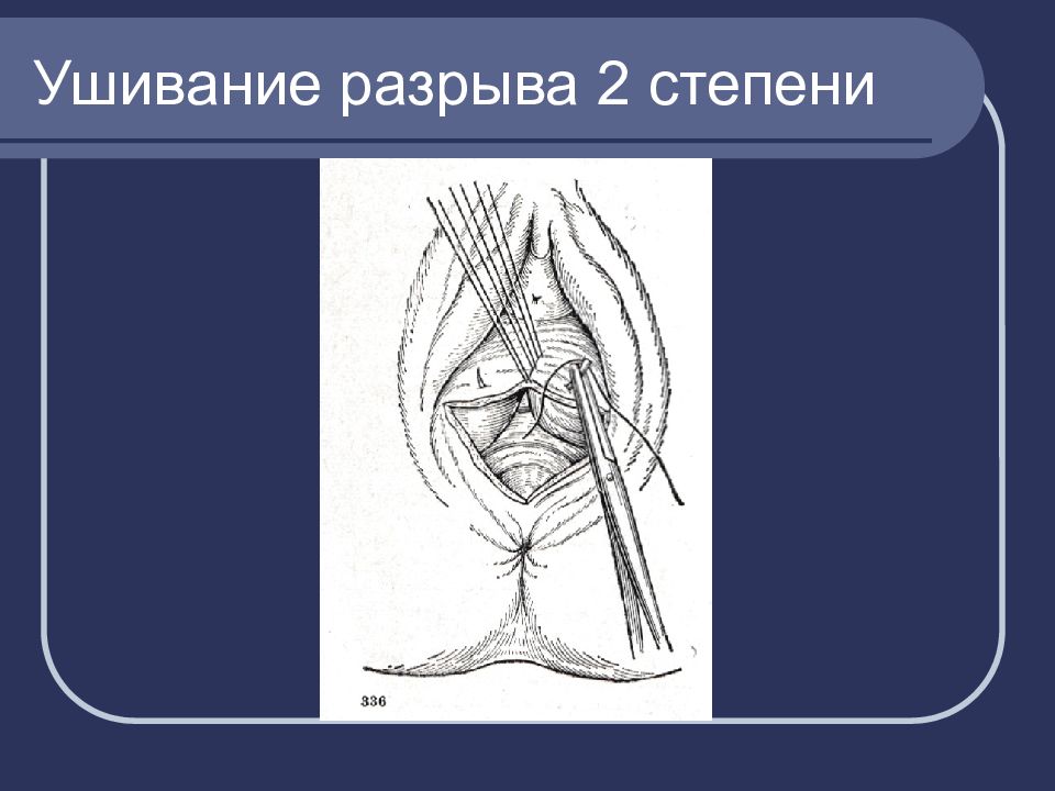 Акушерский травматизм презентация