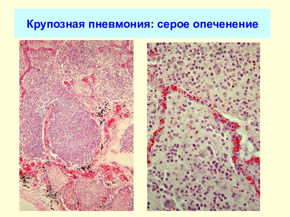 Крупозный трахеит микропрепарат рисунок