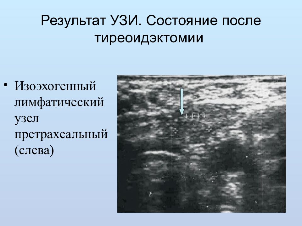 Состояние после. Тиреоидэктомия протокол УЗИ. УЗИ после тиреоидэктомии. Протокол УЗИ после тиреоидэктомии. Заключение УЗИ после тиреоидэктомии.