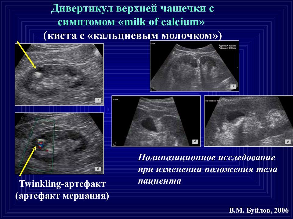 Узи картина мочекаменной болезни