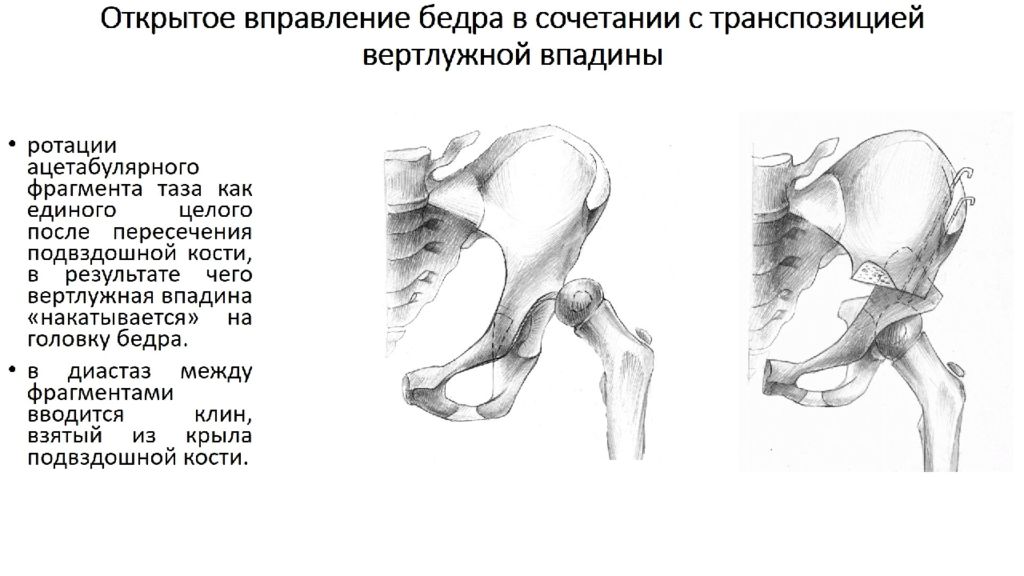 Врожденные вывихи бедра презентация