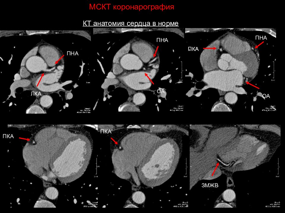 Кт Сердца Фото
