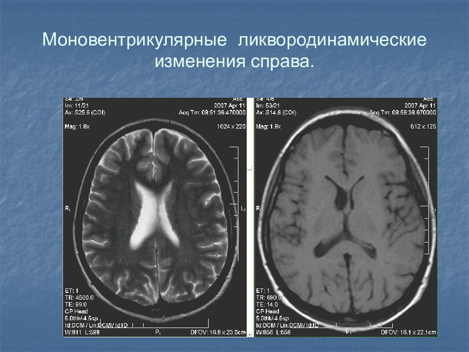 Операция гидроцефалия мозга. Гидроцефалия головного мозга на кт. Внутренняя гидроцефалия на кт головного мозга. Ликвородинамические нарушения головного мозга на мрт. Компьютерная томография головного мозга гидроцефалия.