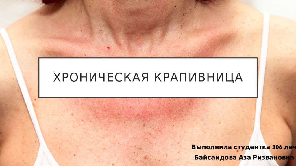 Хроническая крапивница