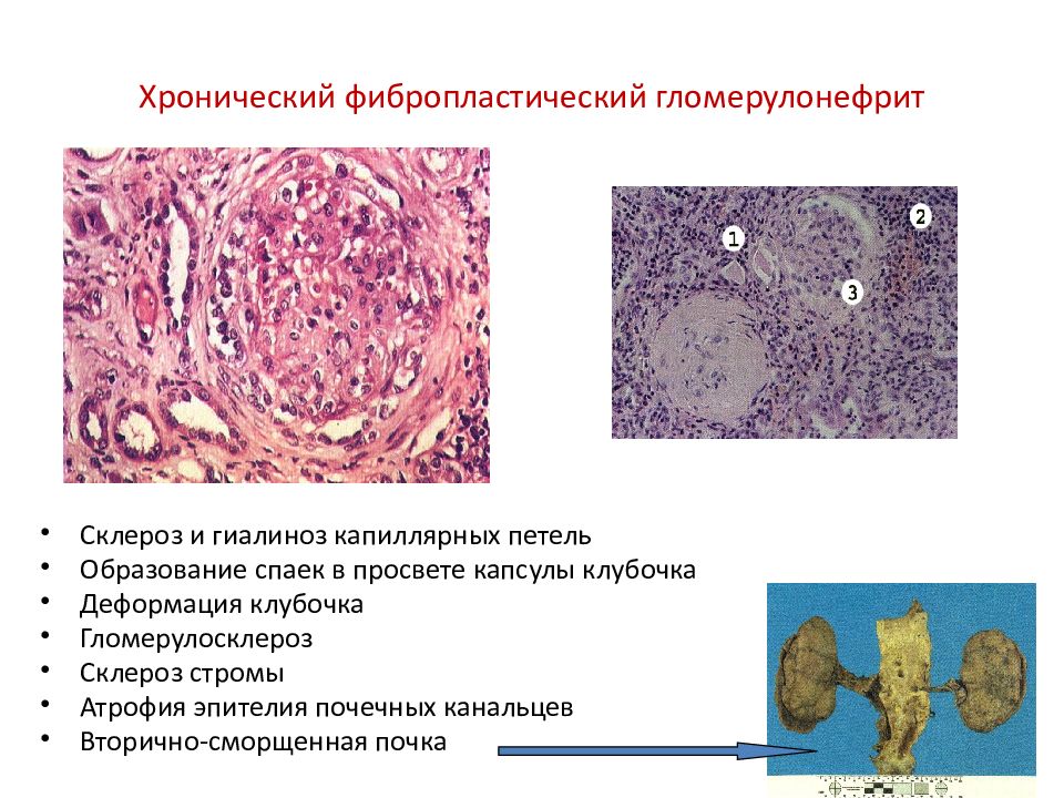 Презентация атрофия и склероз