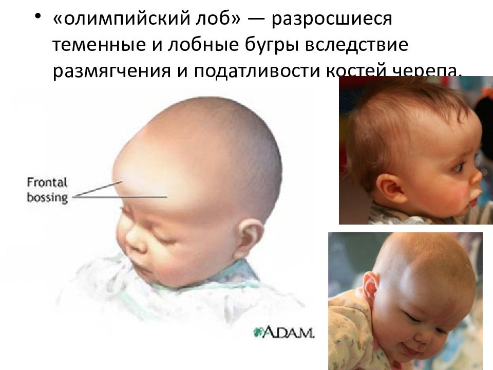 У ребенка выпирает лоб. Рахит форма головы грудничка. Форма головы при рахите у грудничка. Форма черепа у новорожденного при рахите. Рахит деформация черепа.