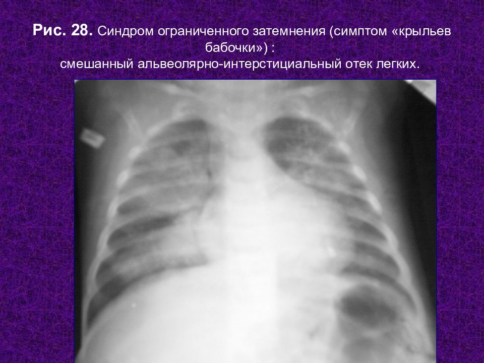 Отек легких симптомы. Кардиогенный отек легких рентген. Интерстициальный отек рентген. Альвеолярный отек легкого рентген. Альвеолярный отёк легких рентген.