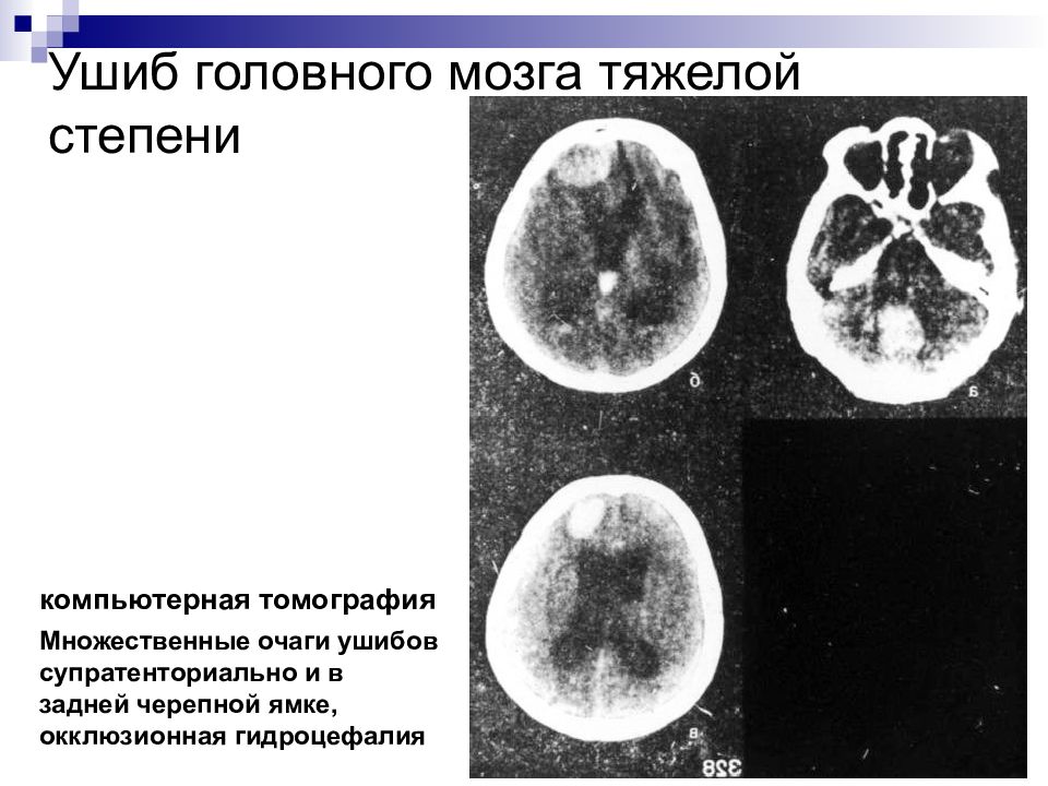 Ушиб клиническая картина