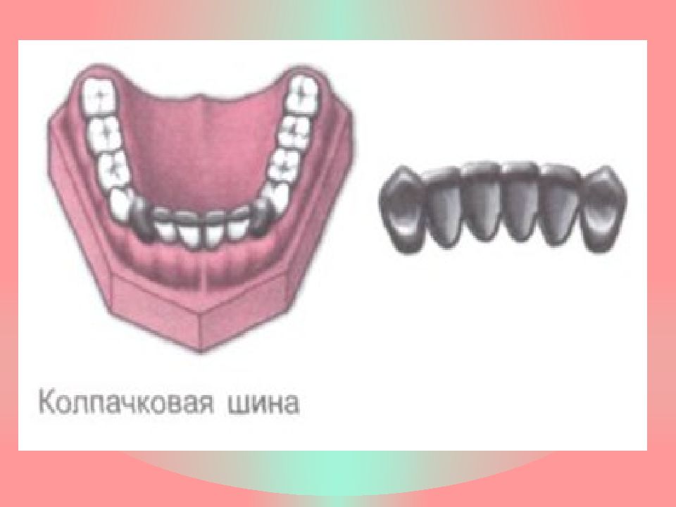 Постоянное шинирование при заболеваниях пародонта презентация