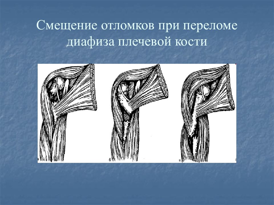 Диафиза плечевой кости. При переломе диафиза плечевой кости. Смещение отломков при переломе диафиза плечевой кости. Перелом средней трети диафиза плечевой кости. Перелом проксимального диафиза плечевой кости.