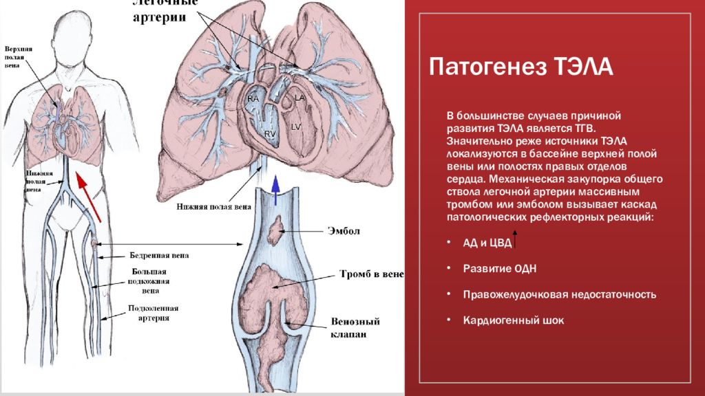 Тромбоэмболия рекомендации. Источники тромбоэмболии легочной артерии. Источники Тэла. Источники Тэла основные. Тэла патогенез.