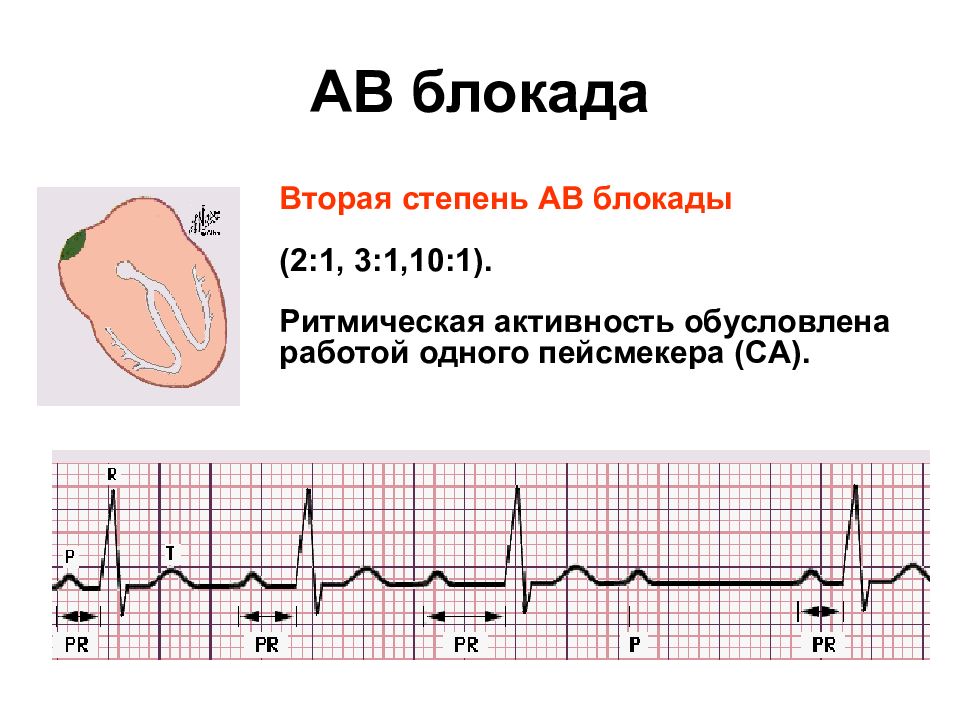 Ав блокада 1. АВ блокада 1 степени характеризуется. АВ блокада 2 степени 3 к 1. АВ блокада 1 степени аускультация. Av блокада 2 степени с проведением 2:1.