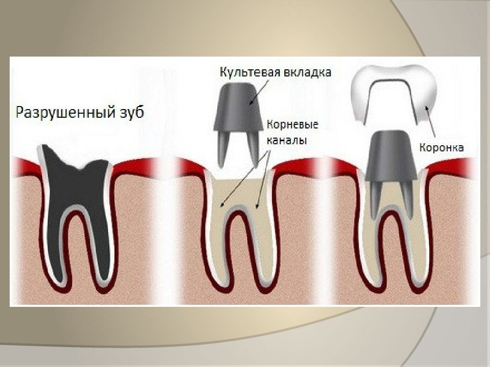 Штифт зубной картинка