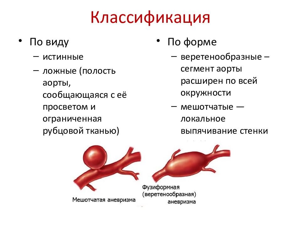 Дилатация аорты