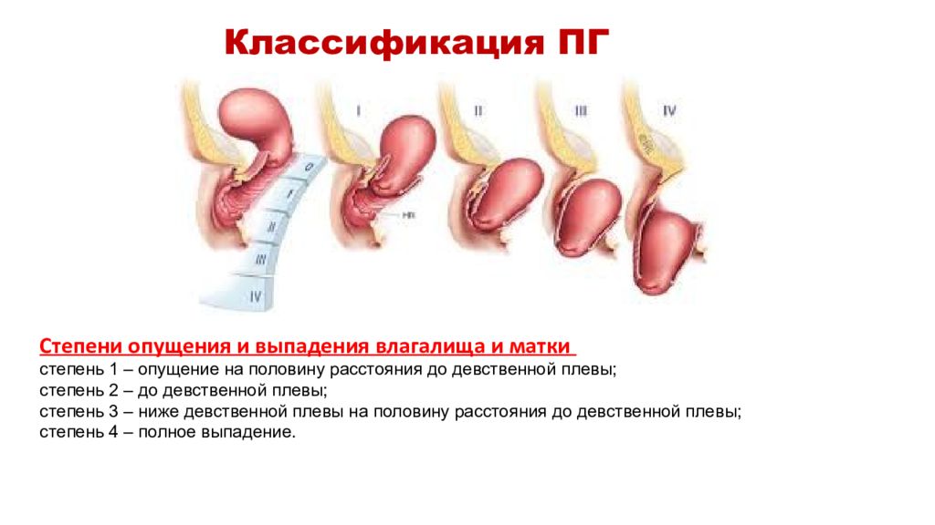 Выпадение Купола Влагалища Фото