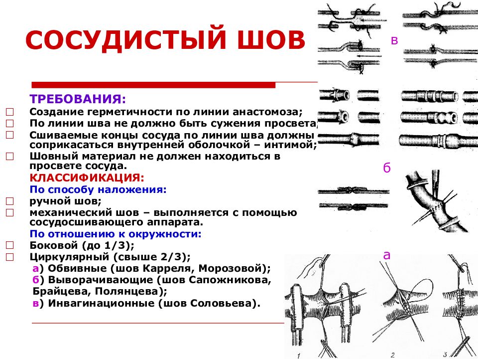 Бесшовное соединение сосудов метод а г коневского. Техника наложения сосудистого шва по Каррелю. Шов сосуда показания и требования к шву сосуда. Сосудистый шов шов по Каррелю. Сосудистый шов по Каррелю и Морозовой техника.