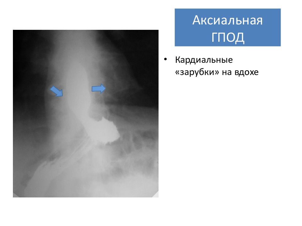 Что такое грыжа пищеводного отверстия диафрагмы. Аксиальная кардиальная грыжа пищевого отверстия диафрагмы. Аксиальная грыжа пищеводного отверстия диафрагмы рентген. Нефиксированная аксиальная кардиальная ГПОД. Аксиальная субтотальная грыжа пищеводного отверстия диафрагмы.