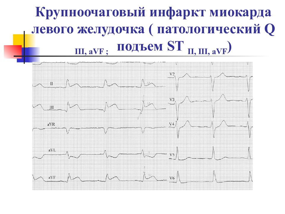 Изменения миокарда левого желудочка. Крупноочаговый инфаркт миокарда. Инфаркт миокарда левого желудочка ЭКГ. Крупноочаговый инфаркт миокарда диагностика. Крупноочаговый инфаркт миокарда признаки.