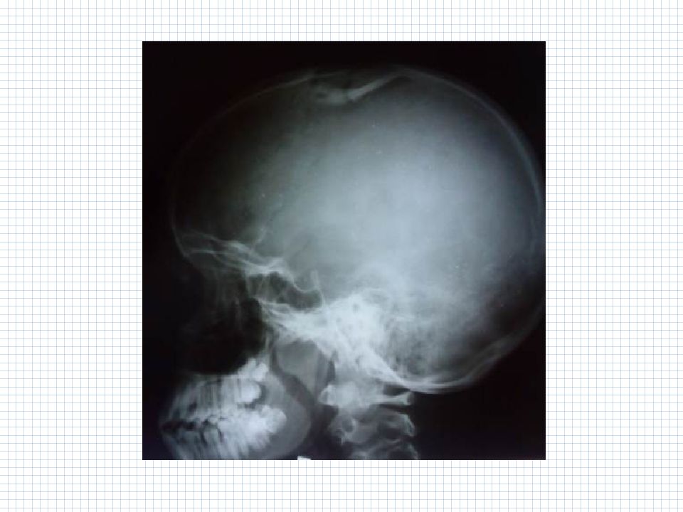 боевые повреждения позвоночника и спинного мозга. повреждения черепа и позвоночника. повреждения черепа и позвоночника. повреждения черепа и позвоночника. течение проникающих ранений черепа и головного мозга.