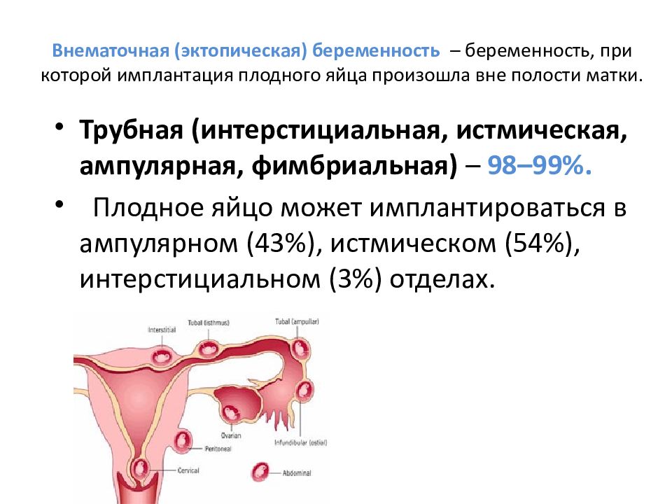 Эктопическая беременность. Трубная внематочная беременность. Ампулярная внематочная беременность. Фимбриальная внематочной беременности. Фимбриальный отдел маточной трубы.