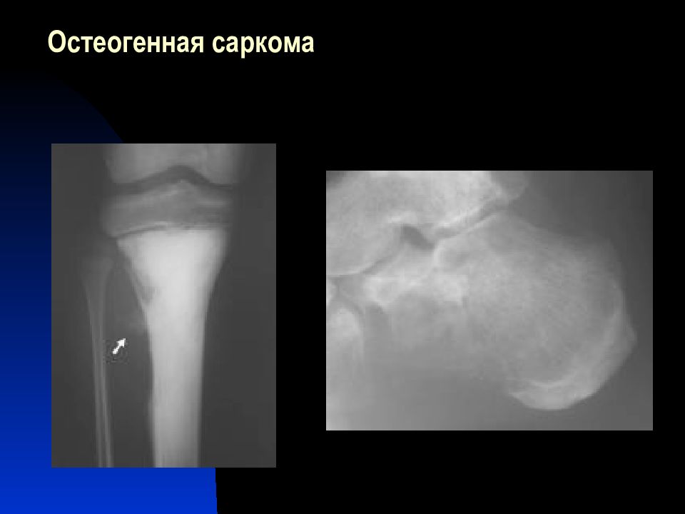 Остеосаркома симптомы. Параостальная остеогенная саркома. Остеогенная саркома рентген. Саркома остеогенная телеангиэктатическая.