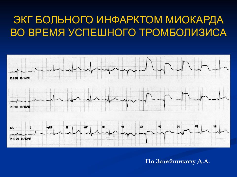 Экг снимки инфаркта миокарда. Острый инфаркт миокарда экг. Экг больного с инфарктом миокарда. Острая стадия инфаркта миокарда экг. Экг больного с инфарктом миокарда.