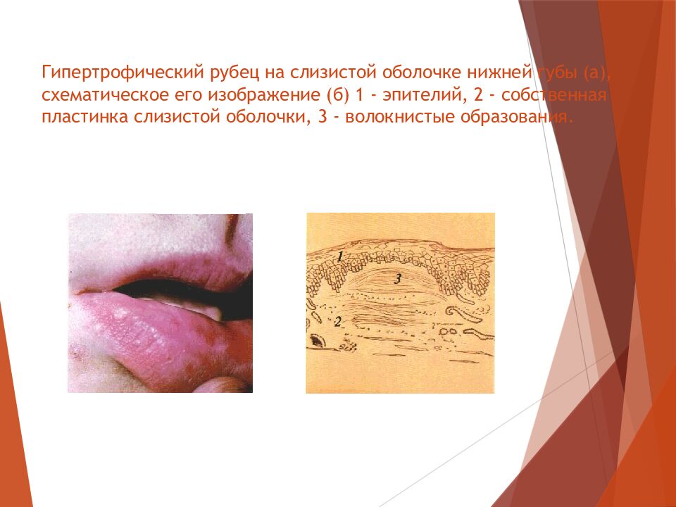 Гипертрофический рубец на слизистой оболочке нижней губы (а), схематическое его изображение (б) 1 - эпителий, 2 - собственная пластинка слизистой оболочки, 3 -