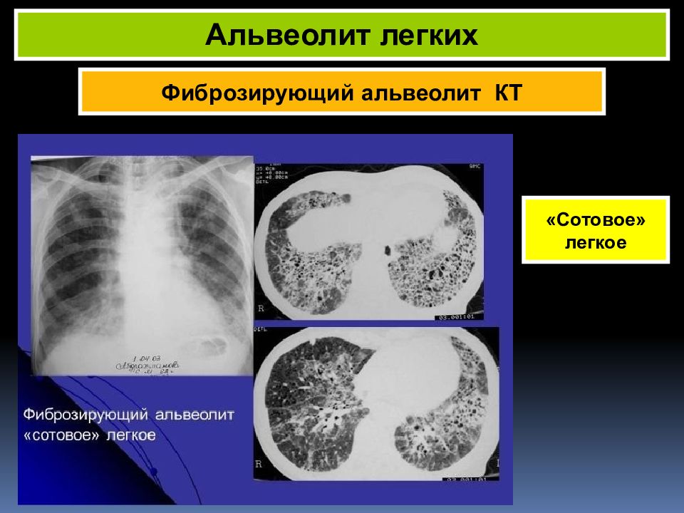 Альвеолит кт картина