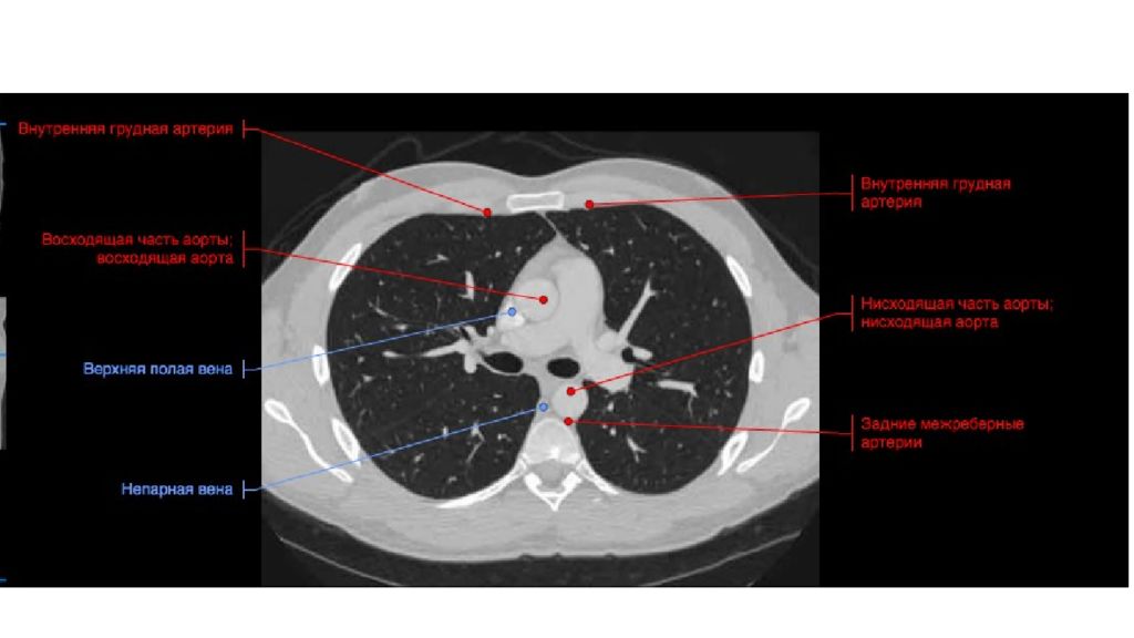 Кт грудной полости. Кт грудной клетки срезы аксиальные. Кт органов грудной клетки с обозначениями. Кт анатомия органов грудной клетки. Кт грудной клетки проекции.