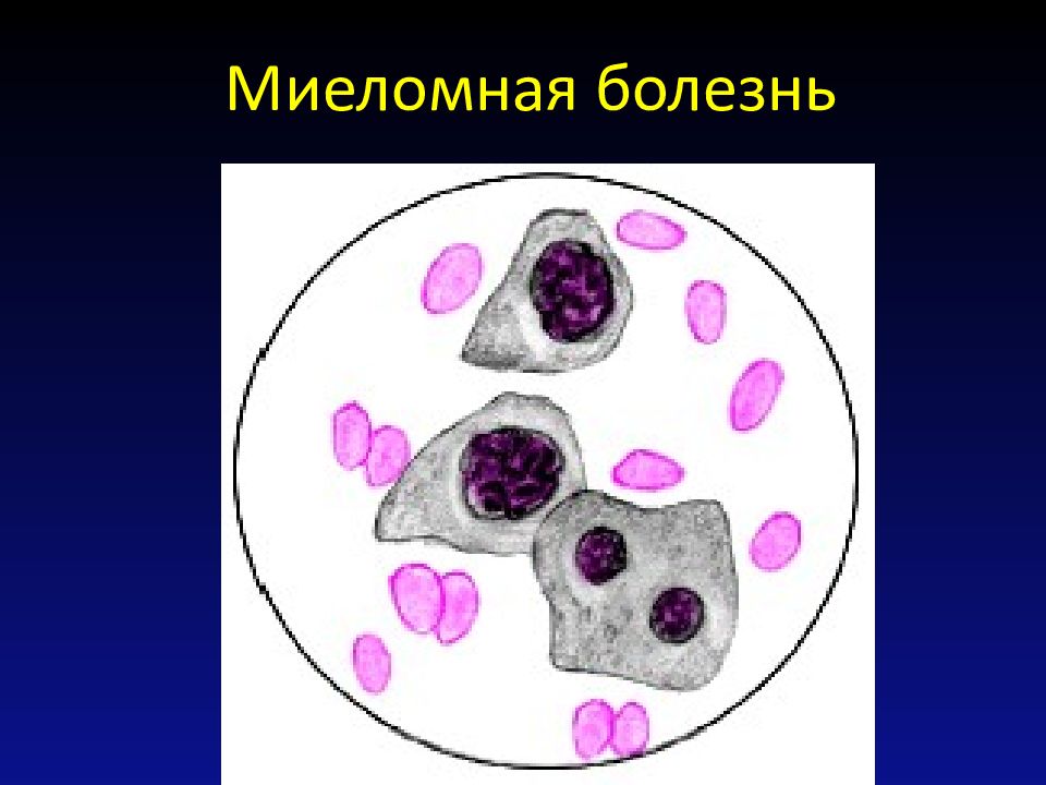 Презентация на тему миеломная болезнь