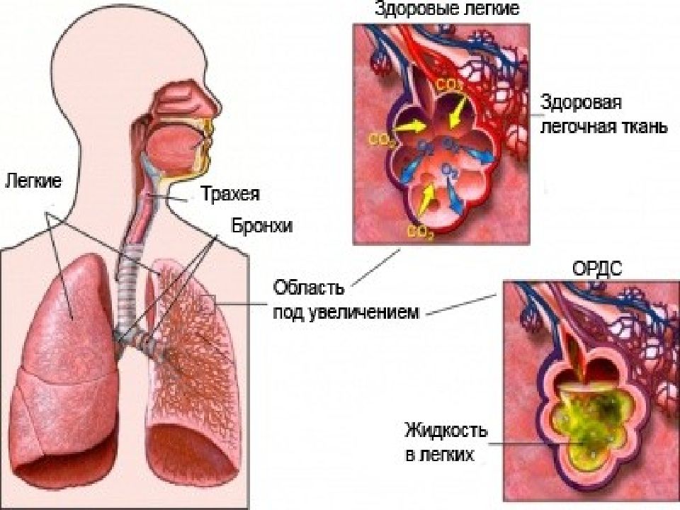 Дистресс синдром презентация