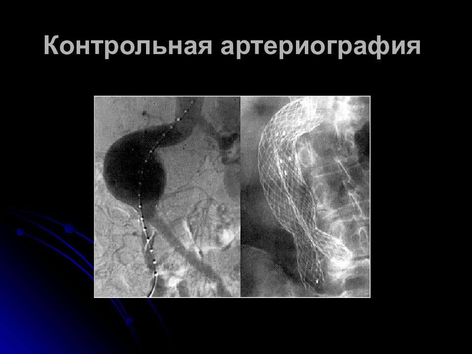 Артериография. Показания к аорто и артериографии. Техника артериографии.